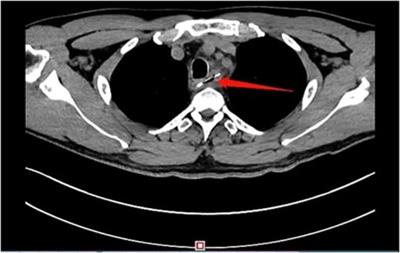 Esophageal foreign body removal under holmium laser-assisted gastroscope: A case report